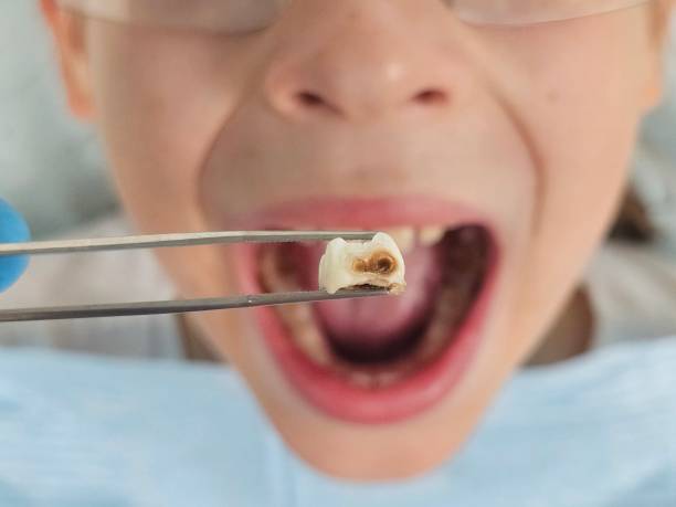 Best Emergency Tooth Extraction in Rock Island, WA